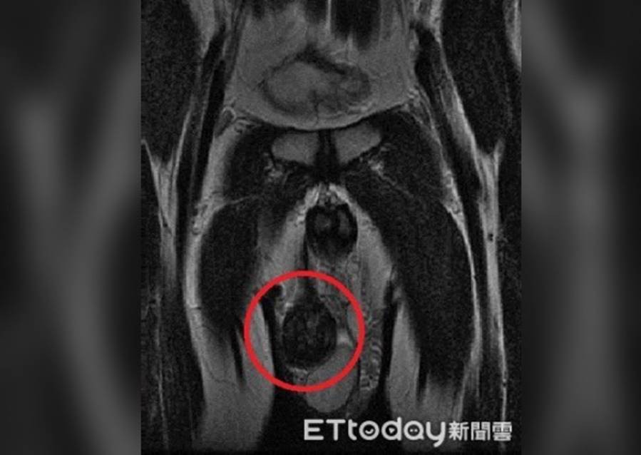 Phát hiện bạn trai có tới 3 tinh hoàn trong lúc âu yếm, cô gái ngã ngửa khi biết sự thật - Ảnh 2. Phát hiện bạn trai có tới 3 tinh hoàn trong lúc âu yếm, cô gái ngã ngửa khi biết sự thật - Ảnh 2.