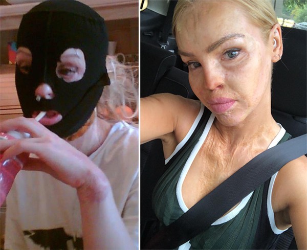 Kinh ho&agrave;ng người mẫu Anh c&ocirc;ng bố bức ảnh bị bạn trai tạt axit - Ảnh 3.