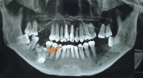 Răng sinh ba - dị dạng răng hiếm gặp - Ảnh 1.