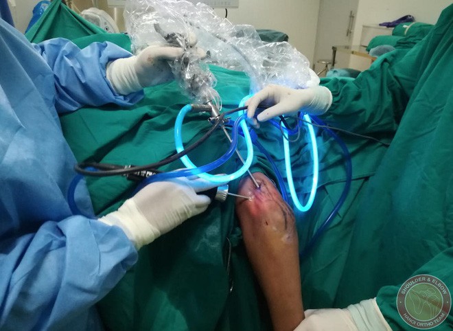 Bác sĩ ngạc nhiên gắp 200 hạt trân châu trắng sữa lổn nhổn trong khớp tay nam thanh niên Hà Nội - Ảnh 2. Bác sĩ ngạc nhiên gắp 200 hạt trân châu trắng sữa lổn nhổn trong khớp tay nam thanh niên Hà Nội - Ảnh 2.