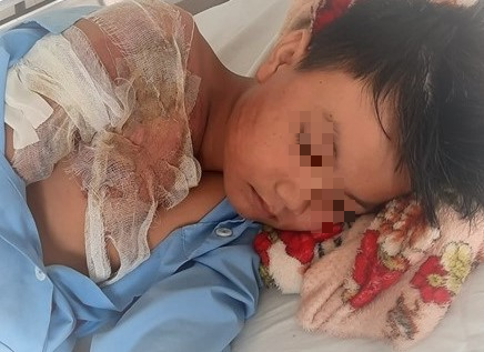 Cháu bé 11 tuổi bị cha ruột tạt nước sôi vào người gây bỏng nặng - Ảnh 1.
