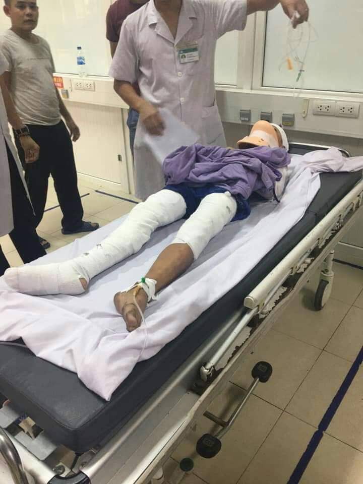 Đứng ở tầng 2, nam sinh lớp 7 bị dây điện trần phóng điện làm cụt 2 cánh tay - Ảnh 4. Đứng ở tầng 2, nam sinh lớp 7 bị dây điện trần phóng điện làm cụt 2 cánh tay - Ảnh 4.