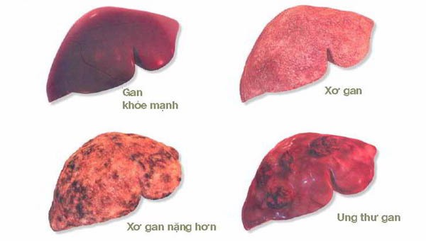 Ngứa liên tục có thể là dấu hiệu của căn bệnh ung thư có tỷ lệ mắc mới nhiều nhất tại Việt Nam - Ảnh 2.