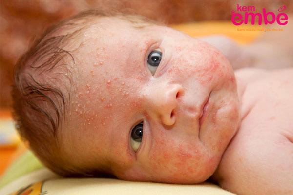 Cách trị mụn sữa ở trẻ sơ sinh để da con luôn trơn láng, mịn màng  - Ảnh 1.