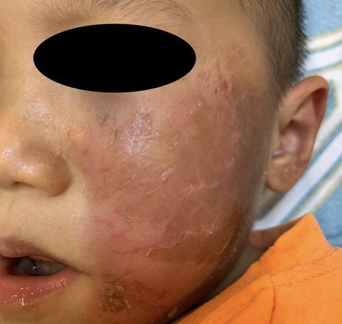  Hóa trang Halloween, bé 4 tuổi bỏng rộp da mặt và khuyến cáo của bác sĩ chuyên khoa - Ảnh 1.
