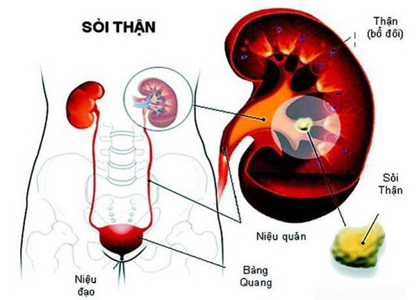 8 thói quen nên bỏ ngay trước khi cơ thể kết đầy sỏi ở thận hay mật - Ảnh 1.