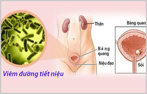 Viêm đường tiết niệu tái phát nhiều người chủ quan nhưng không lường trước được hậu quả đáng sợ thế nào - Ảnh 1.