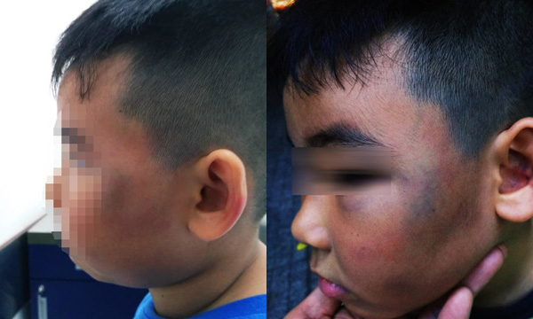Phẫn nộ bé 8 tuổi bị đánh bầm tím mặt vì nghi trộm gà - Ảnh 1.