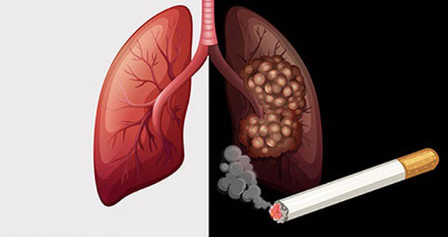 Kinh hãi lá phổi đen kịt của bệnh nhân sau 30 năm hút thuốc, nếu nhìn thấy bạn có còn dám hút thuốc? - Ảnh 2.
