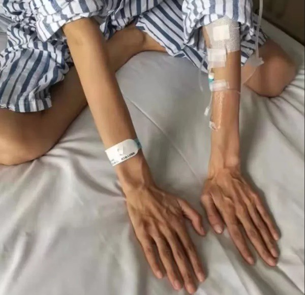 Hội chứng lạ khiến người phụ nữ có chân tay gầy, dài bất thường - Ảnh 1.