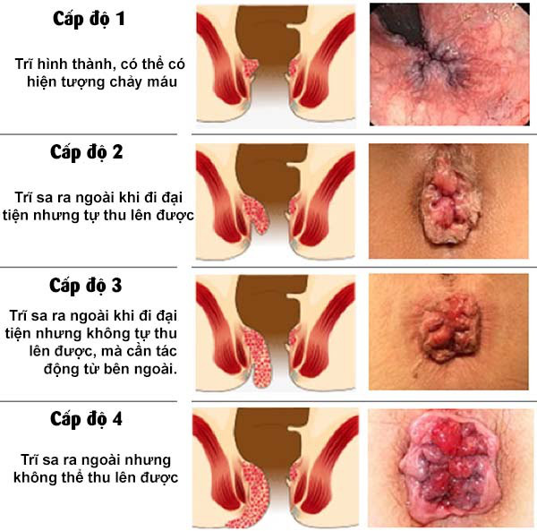 Thực phẩm bảo vệ sức khỏe Triselan  giải pháp hỗ trợ điều trị triệu chứng trĩ, táo bón và suy giãn tĩnh mạch - Ảnh 1.