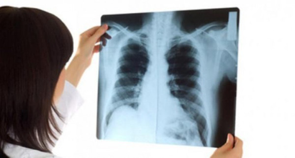 Đừng coi thường khi đau lưng, bởi có thể là dấu hiệu của ung thư phổi - Ảnh 3.
