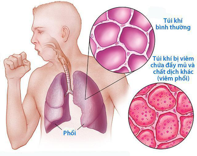 Cải thiện hiệu quả chứng ho kéo dài lâu ngày không khỏi nhờ Bảo Phế Vương - Ảnh 2.