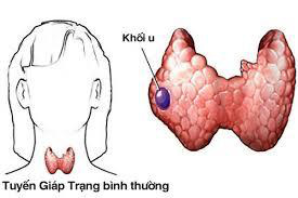 Tại sao người bị u tuyến giáp nên sử dụng Ích Giáp Vương? - Ảnh 1.