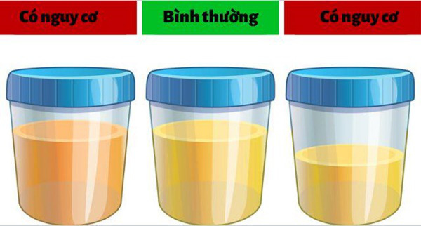 Nếu có 5 dấu hiệu này, nên đi khám thận ngay kẻo bên trong chứa đầy sỏi mà không biết - Ảnh 2.