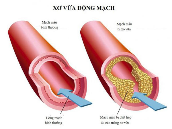 Lipidcleanz - Giải pháp giảm cholesterol, hạ mỡ máu hiệu quả! - Ảnh 3.