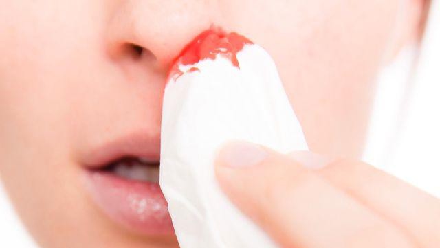 Chảy nước mũi lẫn máu là biểu hiện của bệnh lao mũi