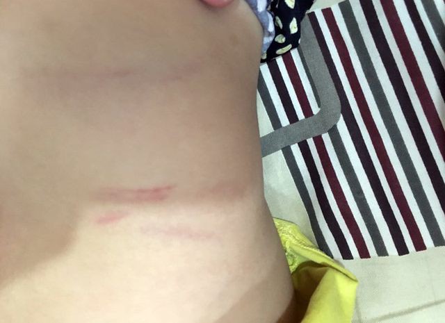 Vết bầm tr&ecirc;n cơ thể b&eacute; do c&ocirc; gi&aacute;o đ&aacute;nh