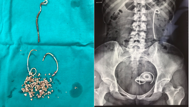 Rất nhiều sỏi được lấy ra và stent jj bị gãy 3 đoạn