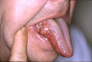 Hình ảnh ung thư lưỡi