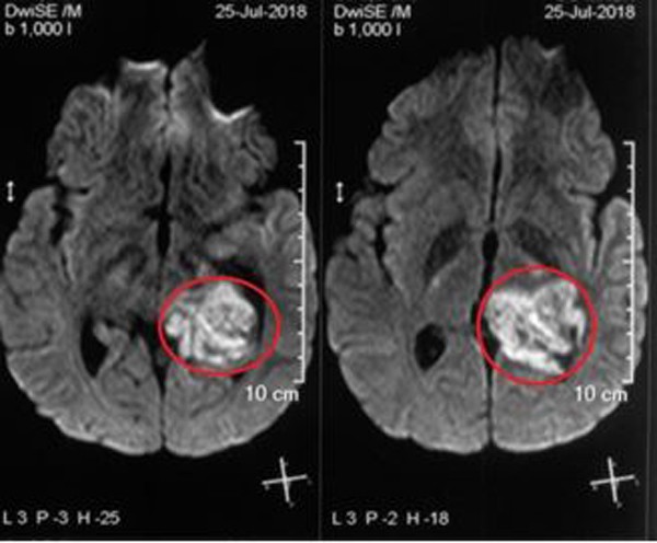 
Hình ảnh khối u ở não bệnh nhân
