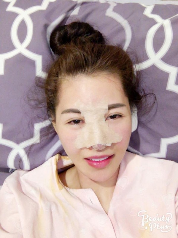 Quế Vân cho biết, cô đã có ý định thẩm mỹ từ 10 năm trước nhưng vì sợ đau, sợ bị hỏng nên đến tận bây giờ mới dám thực hiện.