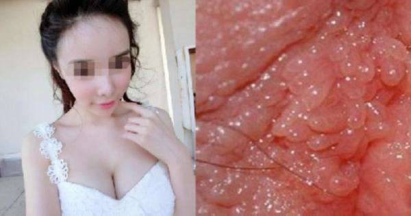 Cô gái 22 tuổi bị mắc bệnh tình dục không rõ nguyên nhân