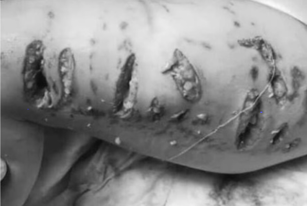 
Bệnh nhi Y bị rất nhiều vết thương phần mềm ở đùi trái, có kèm theo gãy xương kín, vết cắn dài nhất tới 10cm.
