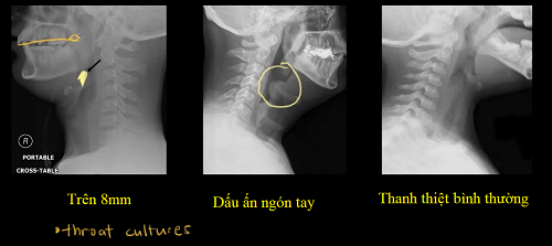 
Hình ảnh bệnh nhân bị viêm thanh thiệt và thanh thiệt ở người bình thường.
