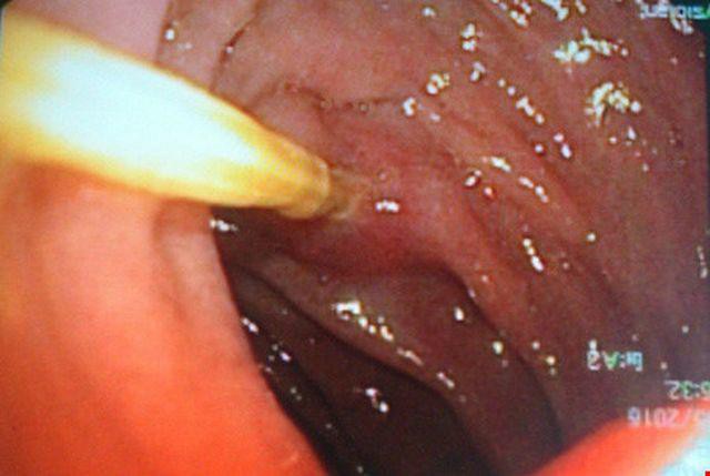Chiếc tăm đâm thủng ruột của Tiểu Lâm
