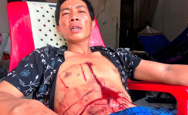  Vết thương trên ngực Nguyễn Hoàng Tâm chảy máu rất nhiều nhưng Tâm vẫn quyết không đến bệnh viện cấp cứu. ẢNH: BẮC BÌNH 