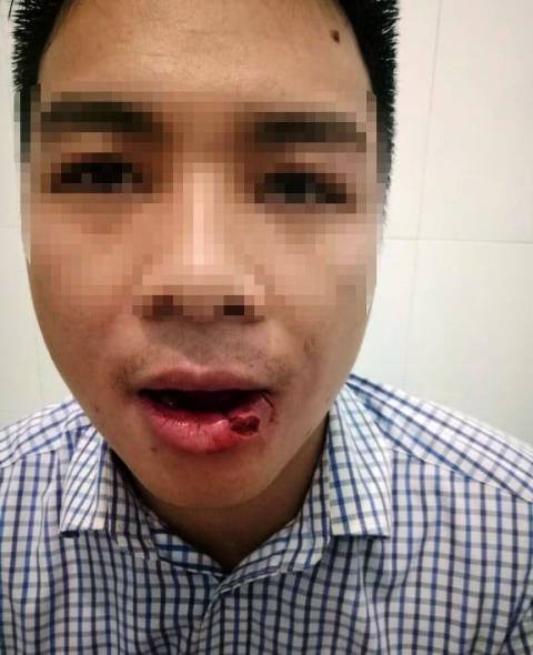 Ông Nguyễn Văn Xiêm bị đánh gãy xương hàm và 5 chiếc răng