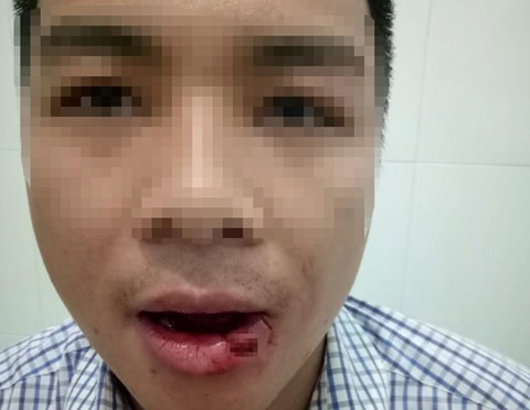 Nạn nh&acirc;n bị g&atilde;y răng, thương t&iacute;ch v&ugrave;ng mặt. Ảnh: T.H