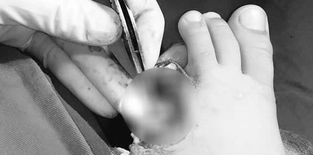 Hai ngón chân bé H bị cắt đứt rời sau khi bị tấm chắn inox xe Airblade cắt.