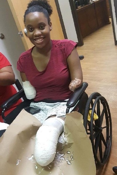 Kayleigh Ferguson-Walker cười lạc quan dù tay chân đều bị cắt cụt hồi năm 2017. Ảnh: GoFundMe.