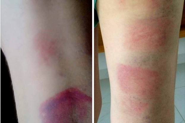 Chân của một học sinh bị bầm tím sau khi bị cô Huyền xử phạt. Ảnh phụ huynh chụp.