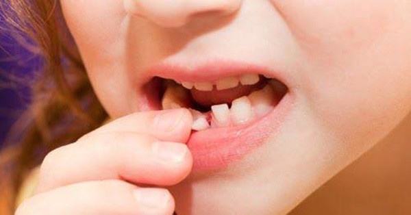 Các tế bào gốc từ răng sữa có thể cứu nguy cho trẻ nếu mắc phải bệnh nguy hiểm, vậy nên cha mẹ nên cất giữ răng sau khi nhổ (Ảnh minh họa)