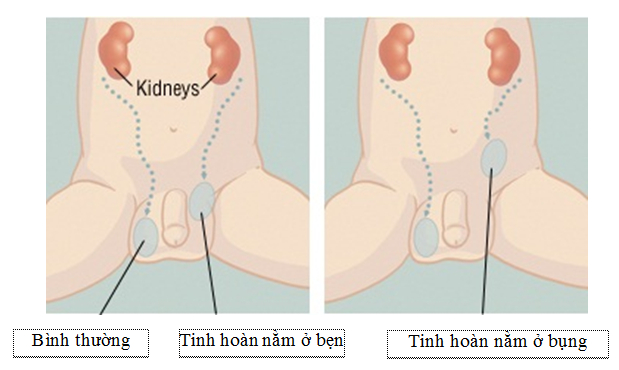 
Ảnh minh họa tinh hoàn nằm ở bụng
