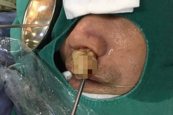 Khối u có kích thước khoảng 6 cm được lấy ra khỏi khoang mũi của bệnh nhân sau gần 2 tiếng phẫu thuật.