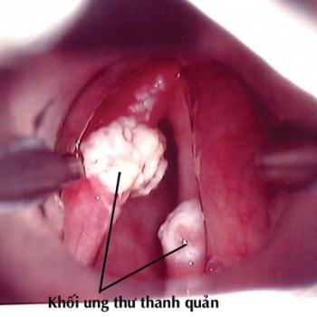 
Hình ảnh ung thư thanh quản
