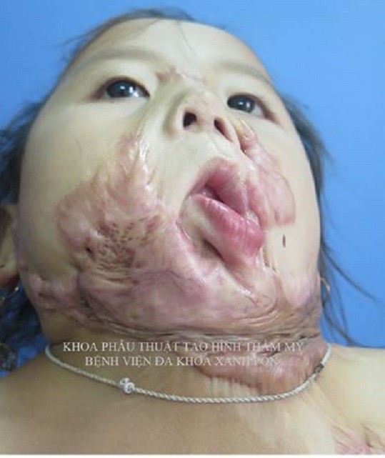 Ca phẫu thuật tạo hình đã mổ khối sẹo lớn dính tịt cằm vào cổ, ngực khiến bé 4 tuổi không thể ngửa cổ. Ảnh: Bệnh viên cung cấp.