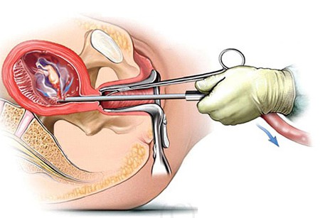 Nạo hút thai có thể dẫn đến vô sinh và nhiều hậu quả nặng nề khác.