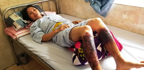 Bà Lê Thị Lan nhập viện trong tình trạng 2 chân bị bỏng nặng. Ảnh: Giang Chinh