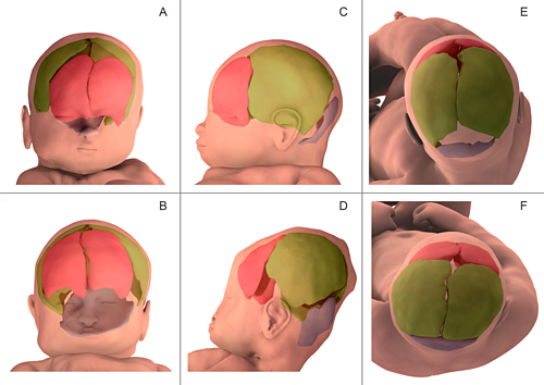 
So sánh phần đầu của trẻ trước khi sinh (A, C, E) và trong khi sinh (B, D, F). Ảnh: Plos one.
