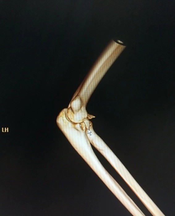 Hình chụp X-quang cho thấy tay của Li bị rách dây chằng.