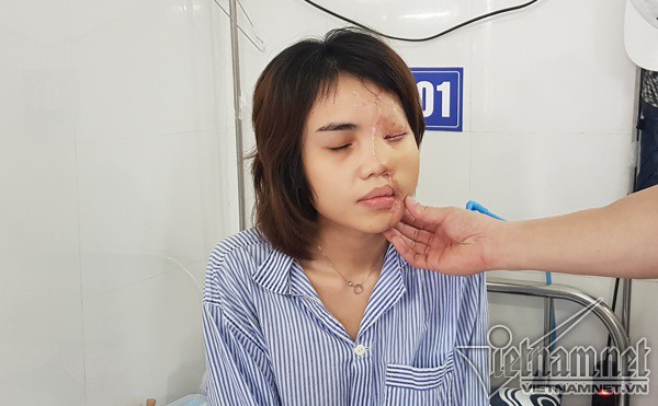 Phần da ghép lên đã sống tốt, có màu sắc và hình dáng khá tương thích với bên còn lại. Thời gian tới, Vy sẽ tiếp tục được chỉnh sửa, cắt gọt thêm để gương mặt thêm hoàn toàn, phục hồi 95% so với diện mạo ban đầu. Ảnh: T.Hạnh