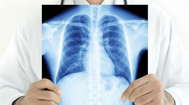 Nguy cơ bị ung thư phổi của những người hút thuốc cao hơn gấp 10 lần so với những người không hút thuốc. Mức độ tăng nguy cơ khác nhau tuỳ theo loại tế bào ung thư. Ảnh minh hoạ: Internet