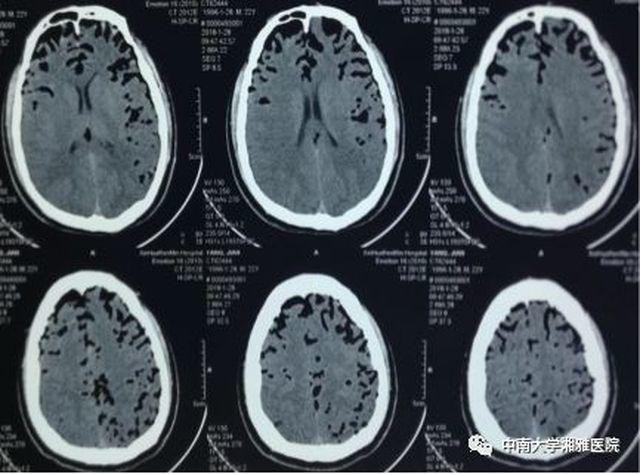 
Hình ảnh chụp CT não của anh Trương
