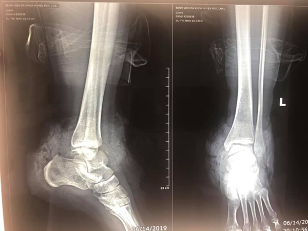 
HÌnh ảnh trước và sau cổ chân bị đứt lìa được các bác sĩ nối thành công. Ảnh: BVCC
