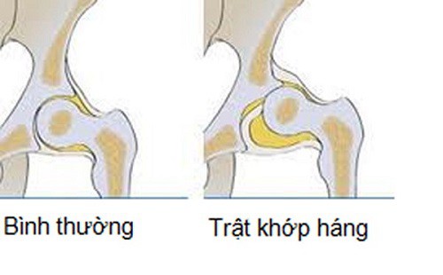 
Hình ảnh khớp háng bình thường và khớp háng bị trật. Ảnh TL
